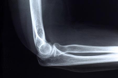 Xray of arm